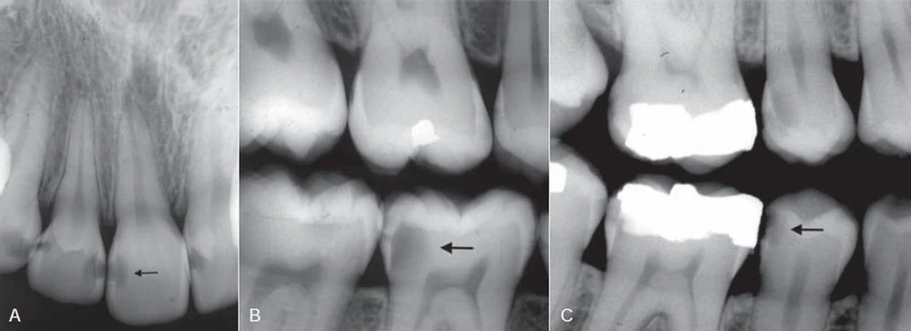 Sâu răng lan rộng vào phần ngà răng