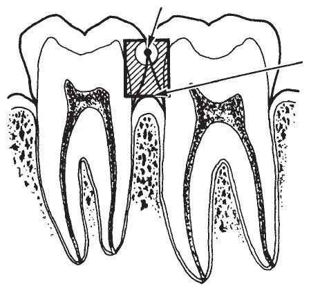 Mặt tiếp xúc bên là vùng dễ bị sâu răng, vùng này đi từ điểm tiếp xúc đến bờ nướu tự do.
