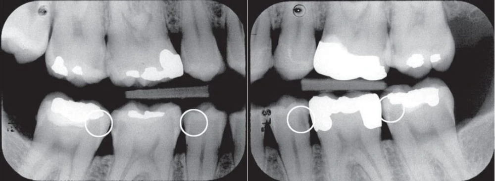 Sâu răng ở răng cạnh răng mang miếng trám do quá trình tạo xoang trám làm tổn thương bề mặt răng kế cân