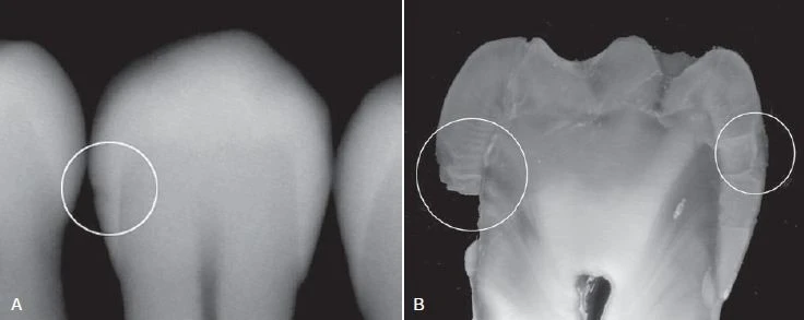 ình ảnh X quang của một răng đã được nhổ với tổn thương nằm ở ngà răng phía bên trái