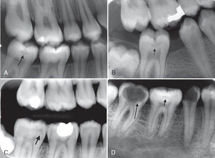 Tổn thương sâu răng mặt nhai khảo sát trên phim X quang