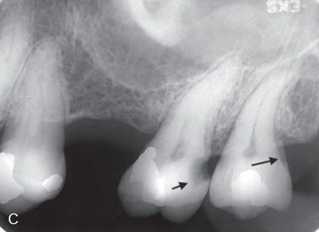 X quang biểu hiện sâu mặt xa cổ răng của răng cối