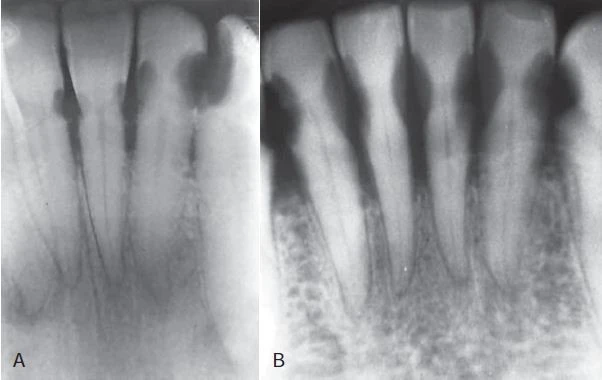 Sâu răng sau xạ trị
