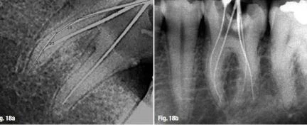 Hình ảnh RVG của răng cối lớn hàm dưới