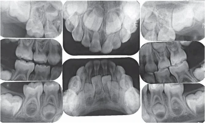 Phim X quang răng sữa bao gồm hai phim mặt phai răng trước, bốn phim quanh chóp răng sau và hai  phim cánh cắn