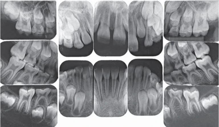 Phim X quang răng sữa gồm hai phim vùng răng cửa, bốn phim răng nanh và bốn phim vùng răng sau và hai phim cánh cắn