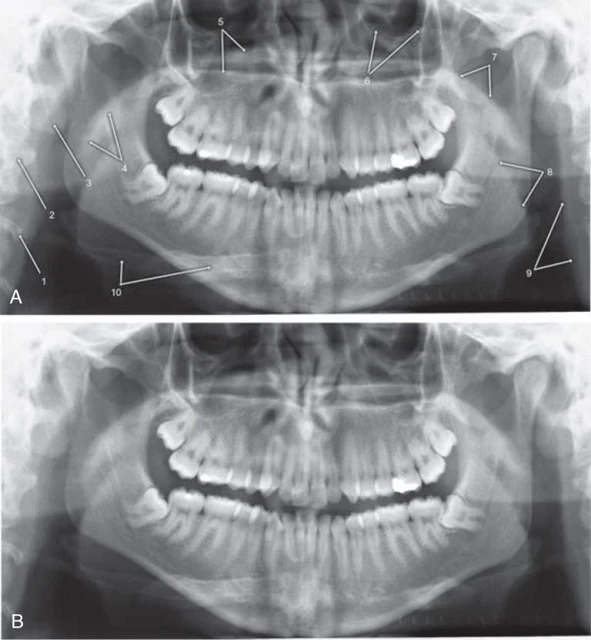 Cấu trúc giải phẫu xương trên phim x-quang toàn cảnh 1