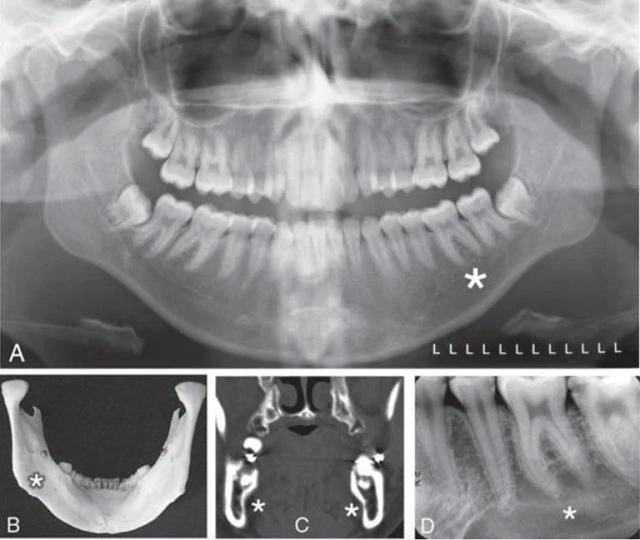Hõm dưới hàm (chỗ lõm tuyến nước bọt lưỡi), một chỗ lõm thường được tìm thấy trên mặt trong phía sau của xương hàm dưới.