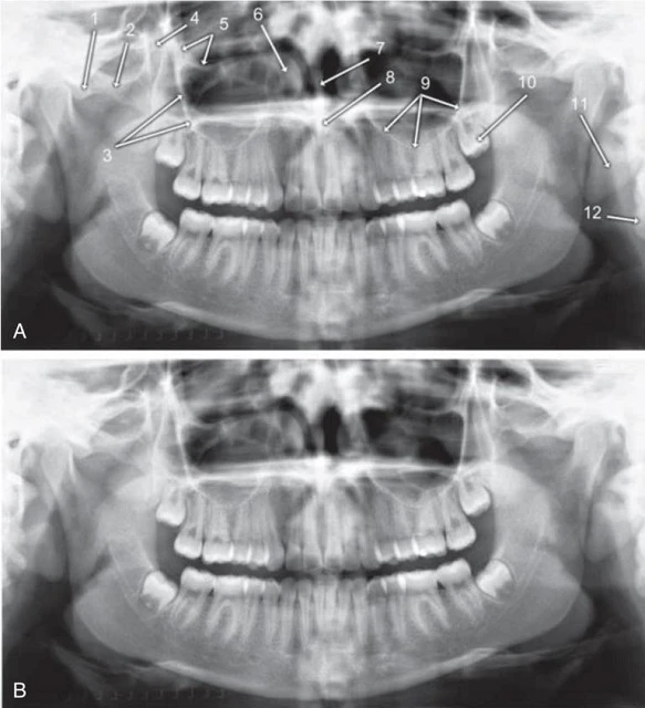 xương hàm trên hoặc tầng giữa mặt, cấu trúc giải phẫu xương trên phim x-quang toàn cảnh