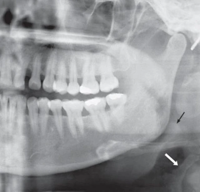 Những cấu trúc thường thấy ở vùng cổ trên phim x-quang toàn cảnh. Mũi tên trắng cho thấy mặt trên của sụn tuyến giáp