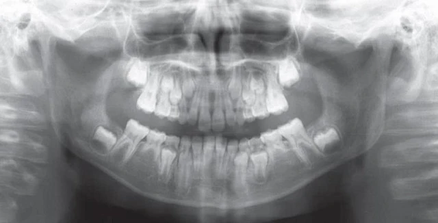 Phim x-quang toàn cảnh cho thấy hình ảnh bộ răng hỗn hợp ở một bệnh nhân 11 tuổi.