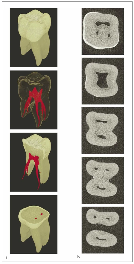 Hình 16-1 Mối quan hệ giữa đường nét bên ngoài của chân răng và khoang tủy qua chụp cắt lớp vi tính. (a) Tái tạo theo không gian ba chiều của răng hàm lớn hàm dưới. (b) Diện cắt ngang của cùng một răng ở các phần khác nhau của ống tủy.
