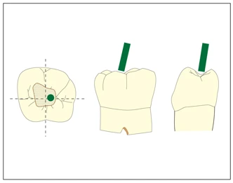 Mở tủy và định vị các lỗ ống tủy sơ đồ minh họa mở tủy răng