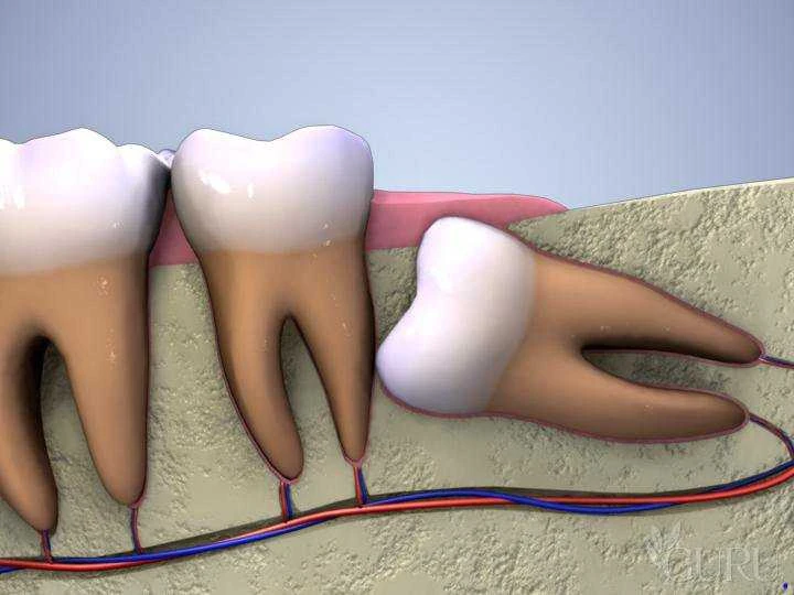 5 bệnh lý răng miệng thường gặp biến chứng răng khôn
