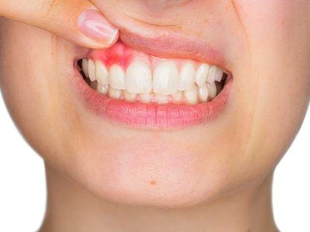 5 bệnh lý răng miệng thường gặp Viêm lợi