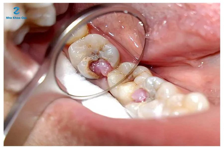 5 bệnh lý răng miệng thường gặp Viêm tủy