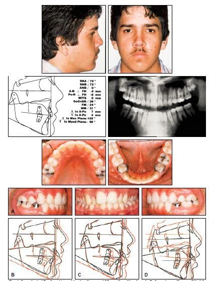Clear aligners: ứng dụng trong nha khoa