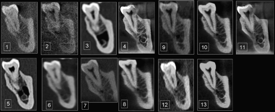 So sánh chất lượng một số loại CBCT và multislice CT trong nha khoa