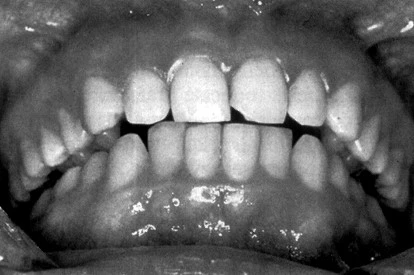vị trí hàm răng