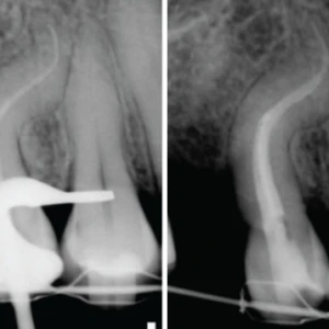 Ống tủy hình S: ca lâm sàng và kỹ thuật xử lý phần 2 - 19 file