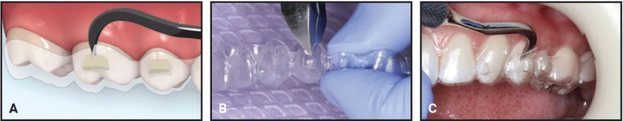 Kĩ thuật gắn attachment invisalign cải tiến