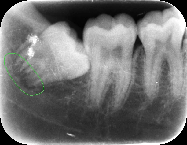 U biểu mô do răng canxi hóa