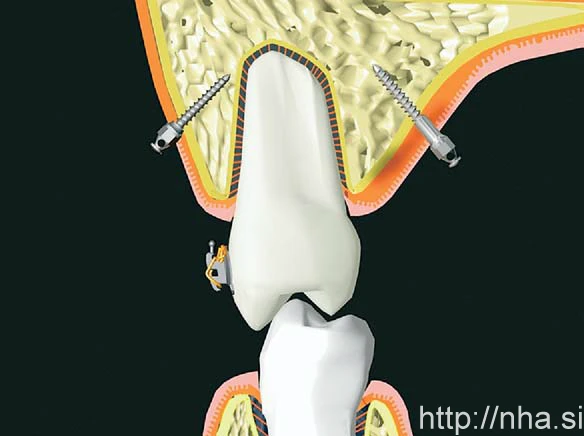 Minivis cần được cắm tối thiểu 6 mm vào xương hàm trên