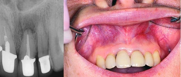 Hình ảnh X quang cho thấy nang quanh chóp răng cửa giữa mà nguyên nhân do điều trị nội nha chưa tốt. Chưa xuất hiện hình ảnh lỗ rò trên lâm sàng.