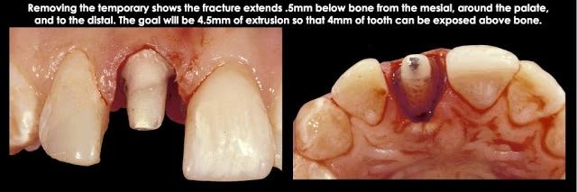 Điều trị xâm phạm khoảng sinh học ở mặt bên một răng trước đơn lẻ