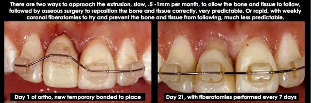 Điều trị xâm phạm khoảng sinh học ở mặt bên một răng trước đơn lẻ