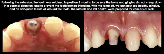 Điều trị xâm phạm khoảng sinh học ở mặt bên một răng trước đơn lẻ