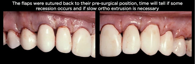 Điều trị xâm phạm khoảng sinh học trên những case phức tạp