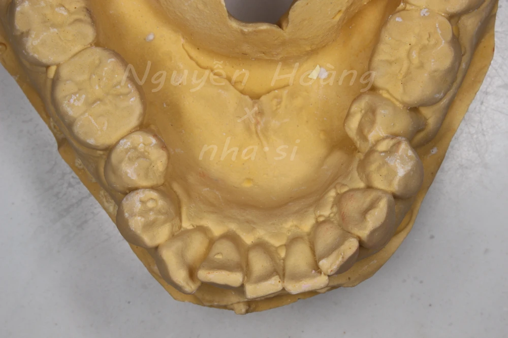 Dựng trục răng hàm nhỏ trong phục hình răng sứ thẩm mỹ