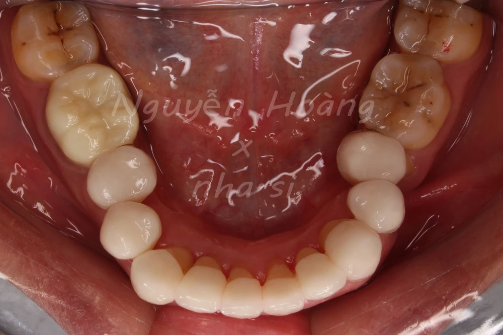 Dựng trục răng hàm nhỏ trong phục hình răng sứ thẩm mỹ