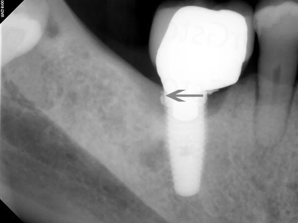 5-loi-khuyen-implant
