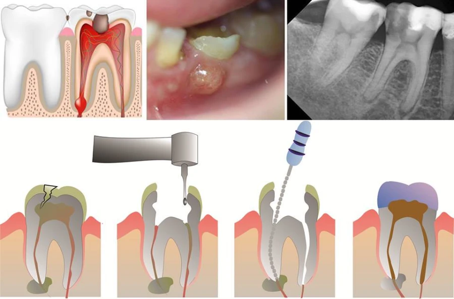 Xử lý khẩn cấp nội nha (phần 2)