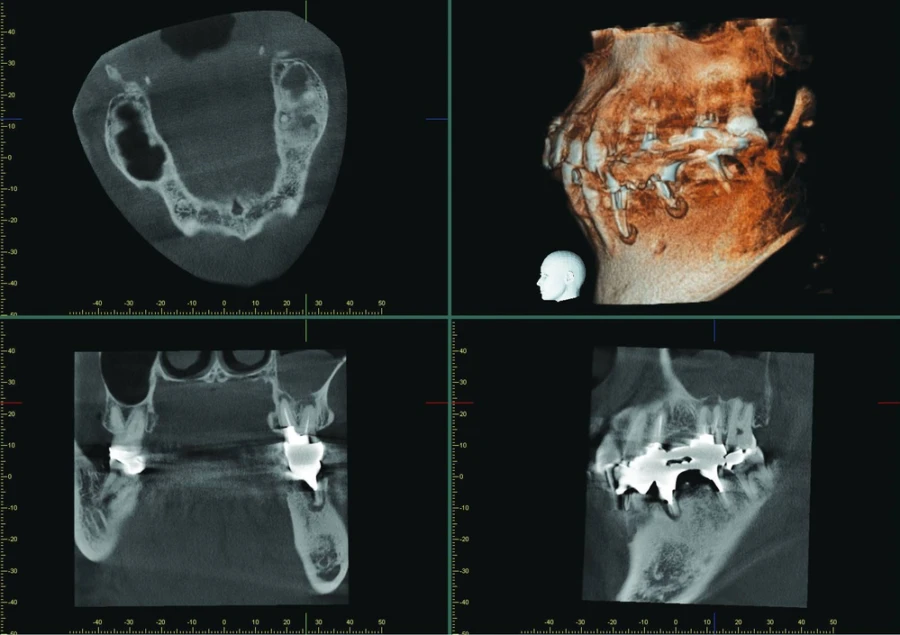 Cone BEAM computed Tomography in endodontics