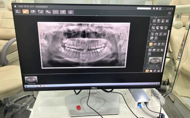 Phim toàn hàm được chụp bởi X-quang IC5 HD Morita