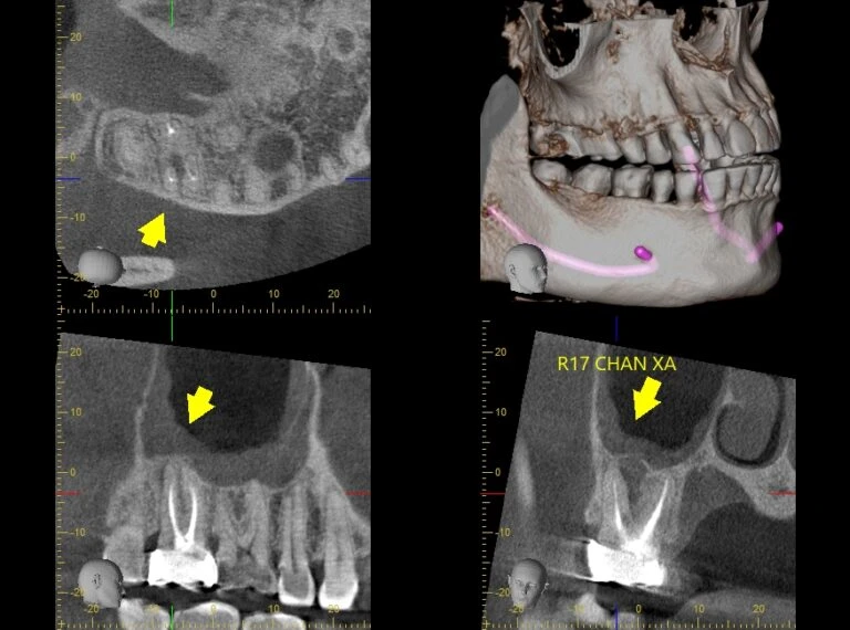 Chụp CBCT R17 CHAN XA