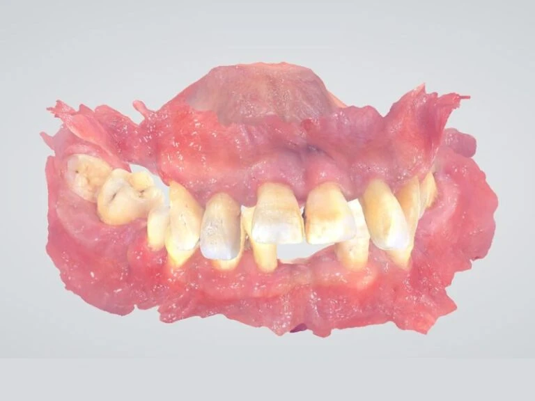 Hình ảnh 2 cung hàm sau khi lấy dấu bằng phương pháp kỹ thuật số