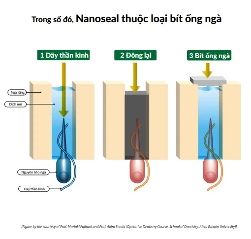 Nanoseal là chất chống nhạy cảm ngà theo cơ chế bít ống ngà