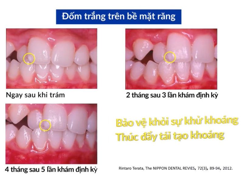 Nanoseal thoa dùm trang Ê buốt ngà