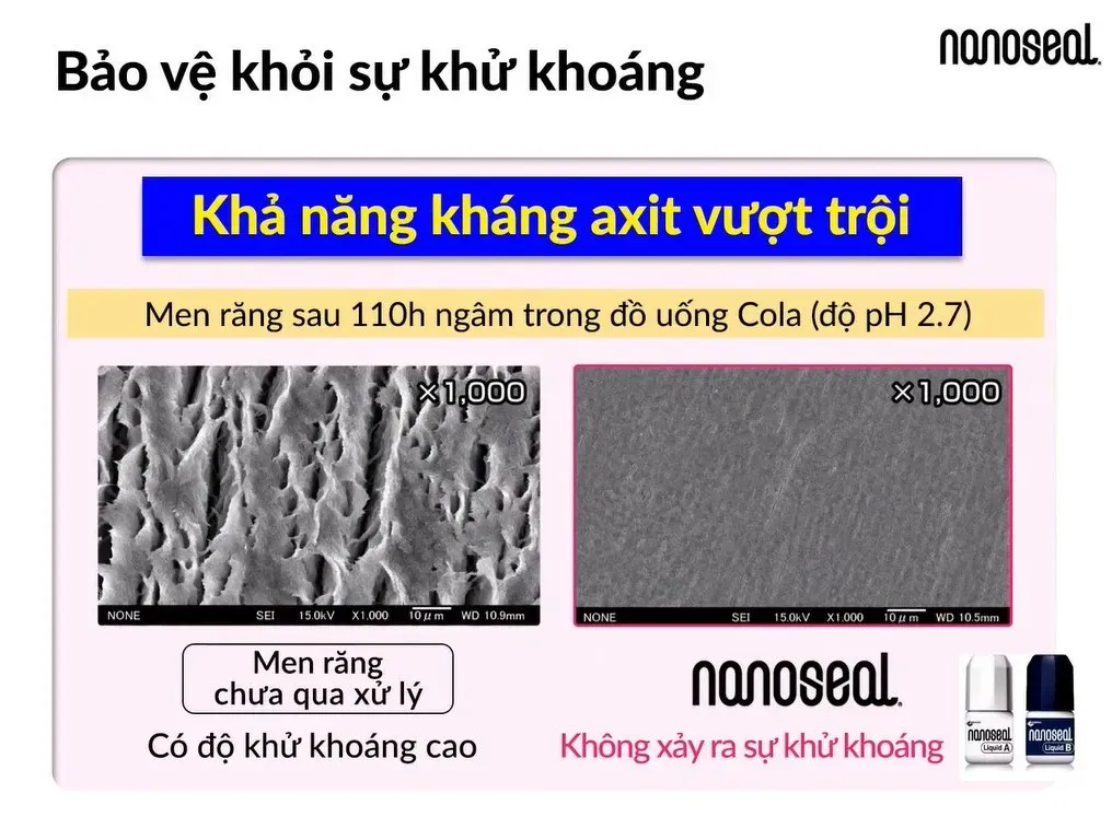 Nanoseal – hiệu quả ngừa ê buốt đã được chứng minh