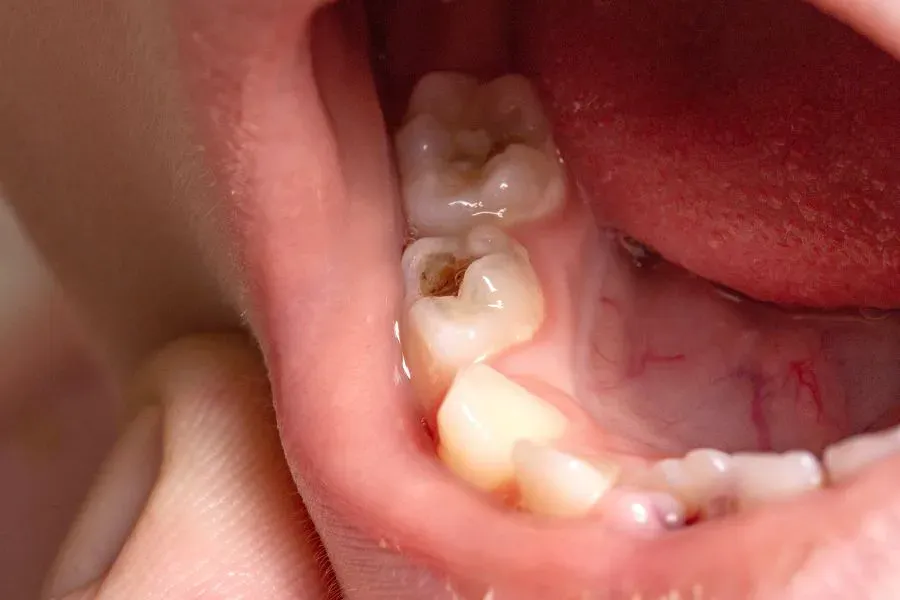 biến chứng sâu răng
