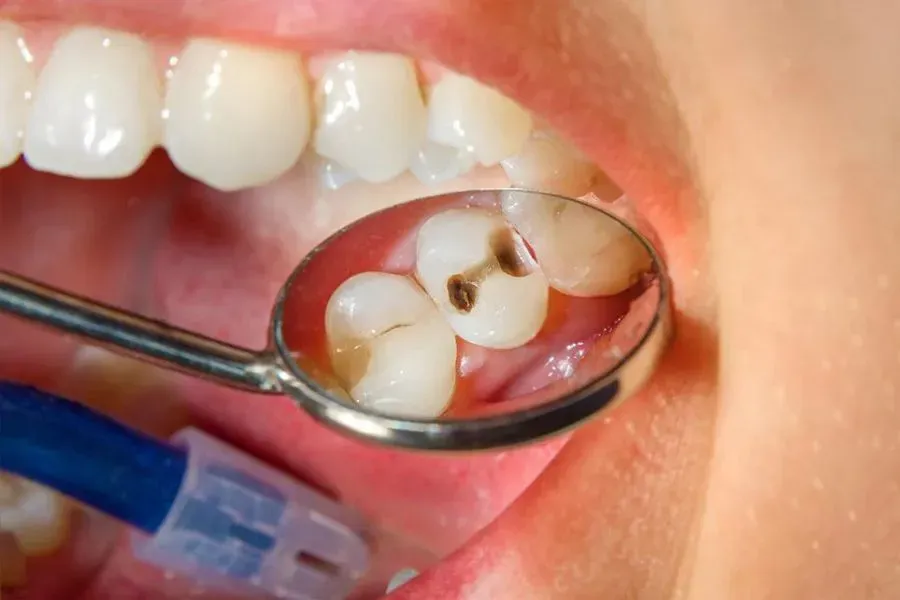 phương pháp chấn đoán sâu răng