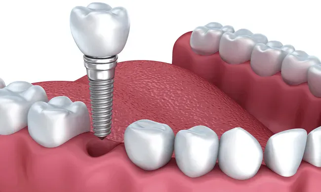 Biến chứng implant nha khoa