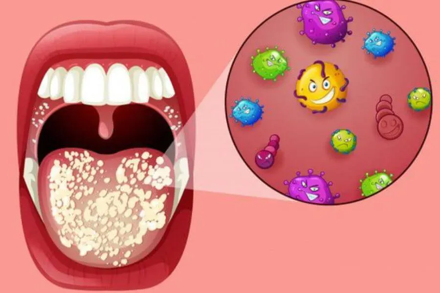 Nguyên nhân gây sâu răng ở người lớn