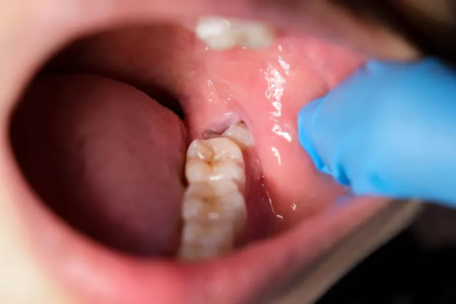 chẩn đoán sâu răng