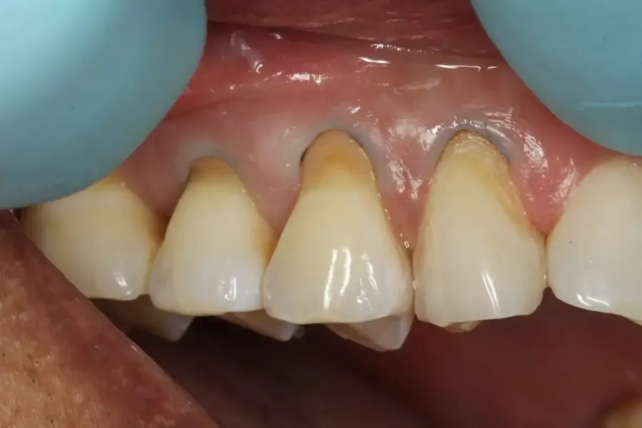 khắc phục tình trạng mòn cổ răng
