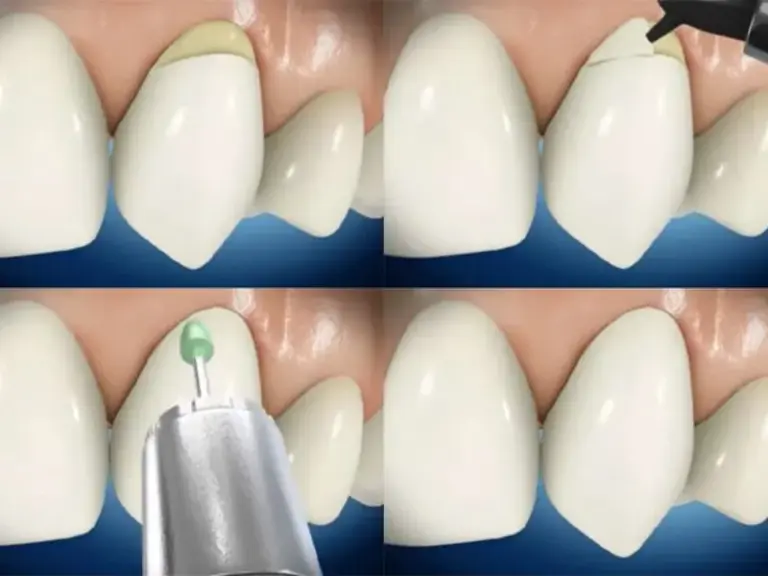 khắc phục tình trạng mòn cổ răng